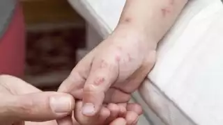 Confirman 17 niños contagiados por virus CoxSackie en preescolar de Tankunché, Calkiní