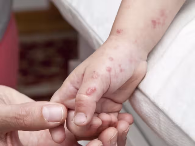 Padres ignoran recomendaciones y brote de CoxSackie se sale de control en Tankuché