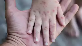 Coxsackie aumenta en Campeche: Van 49 casos este 2025 con 6 nuevos contagios; ¿dónde se concentran?