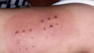 Siete niños sanaron del “Coxsackie” en Tankuché; SEDUC descarta contagio en otras localidades