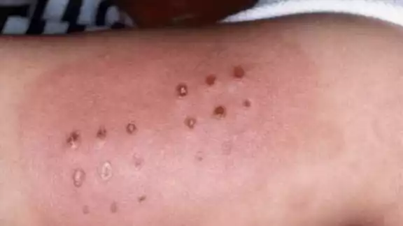 Esta enfermedad viral afecta principalmente a niños en edad preescolar. Esta enfermedad viral afecta principalmente a niños en edad preescolar.