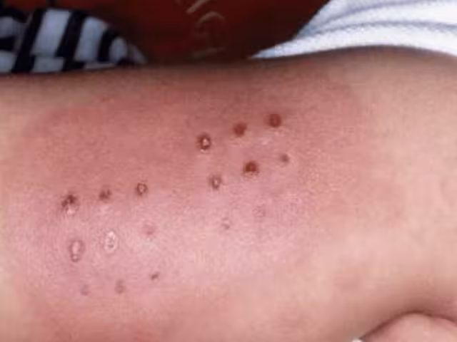 Esta enfermedad viral afecta principalmente a niños en edad preescolar.