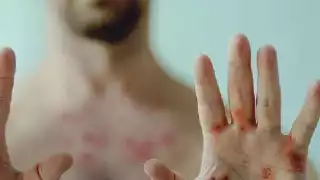 Aumenta crisis por mpox en África con más de 540 muertos y 18 mil casos en 2024