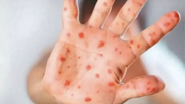 En México no se ha registrado ningún contagio de la variante más letal de mpox