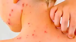 Suman 19 muertes por sarampión en 2025, niños son los más afectados y México lidera tasa de mortandad en América Latina