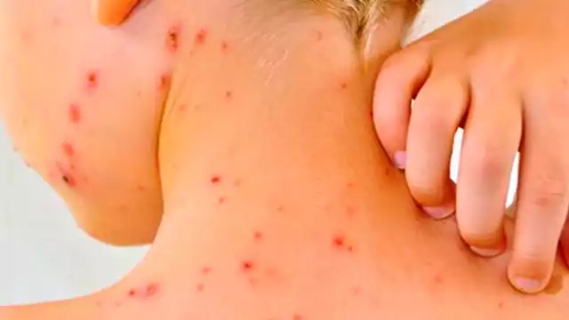 México encabeza la lista de mortandad por sarampión durante 2025