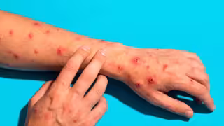 ¿Qué es la Mpox y cómo se contagia? Esto debes saber ante los casos en Yucatán