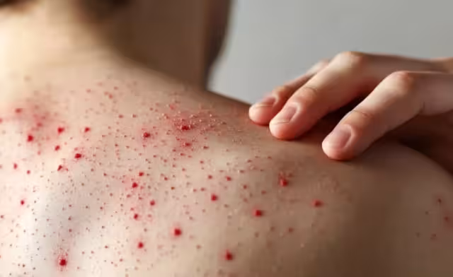 Campeche registró tres nuevos casos de sarampión, todos en el municipio de Hopelchén, sumando 12 contagios en lo que va de 2025