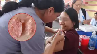 Casos de infección de VPH en mujeres en Quintana Roo aumentan