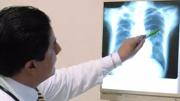 Pese a que se han registrado avances médicos, la bacteria sigue propagándose entre la población