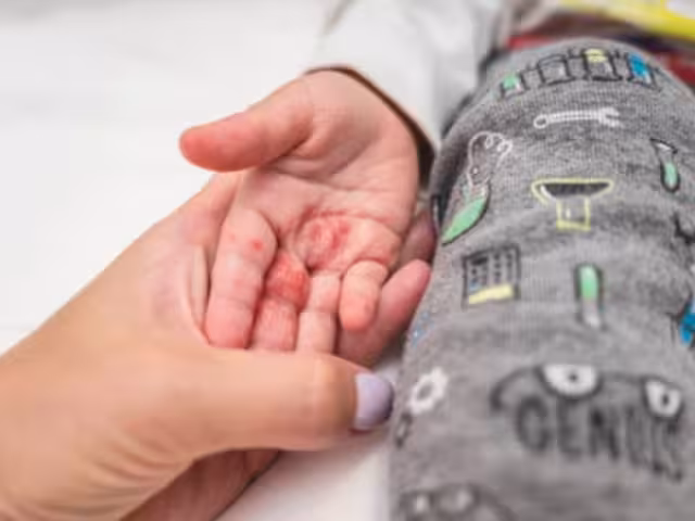 Confusión entre Coxsackie y sarampión preocupa a padres y autoridades de Campeche