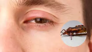 Enfermedad de Chagas avanza en Campeche: 70% de los afectados no lo saben