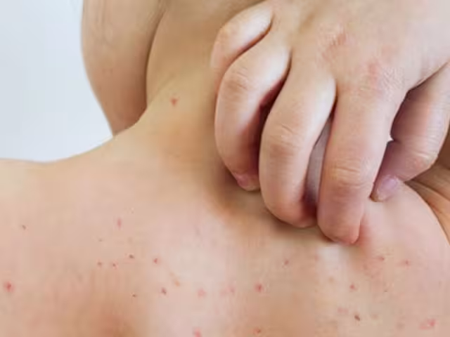La OMS subrayó que varios de los brotes están relacionados con viajeros que importaron el virus desde otras regiones