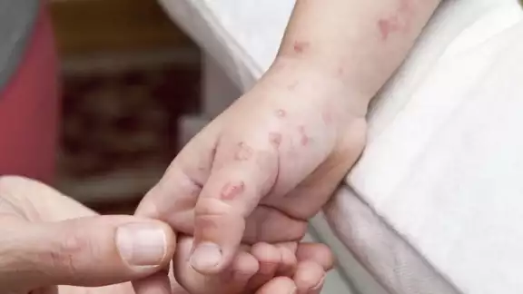Educación y Salud se unen para prevenir el virus Coxsackie en alumnos Educación y Salud se unen para prevenir el virus Coxsackie en alumnos