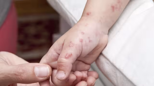 Educación y Salud se unen para prevenir el virus Coxsackie en alumnos