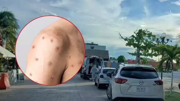 Se reportó cerca de la medianoche que no se trataba de un caso de viruela símica Se reportó cerca de la medianoche que no se trataba de un caso de viruela símica