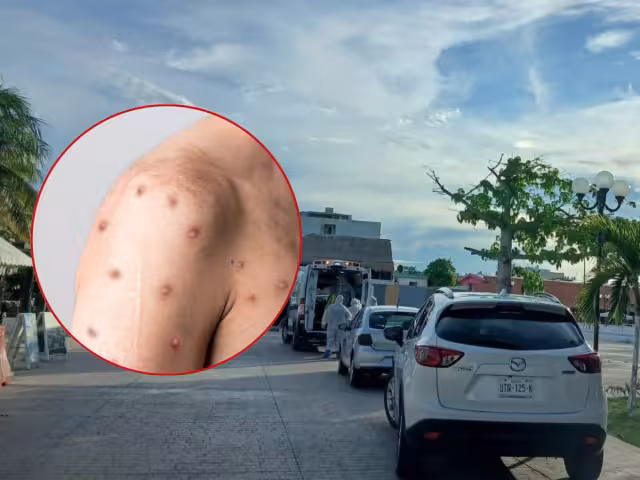 Se reportó cerca de la medianoche que no se trataba de un caso de viruela símica