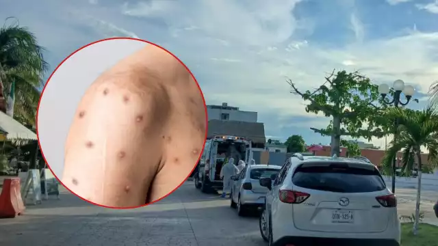 Se reportó cerca de la medianoche que no se trataba de un caso de viruela símica