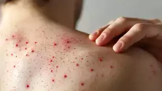 Alcalde de Hopelchén niega brote de sarampión y asegura que 'casos activos' son de la cabecera