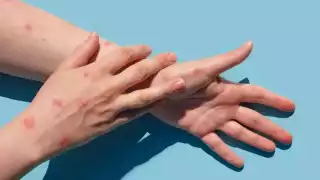 Confirman primer caso de mpox en Paquistán, además de dos contagios sospechosos