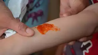 Alerta en Cancún por aumento de mordeduras de animales