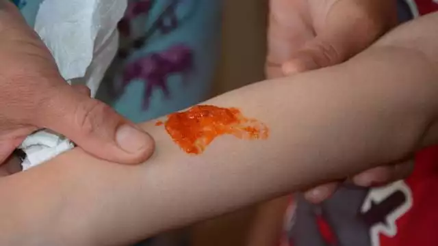 Alerta en Cancún por aumento de mordeduras de animales