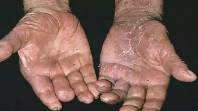 Campeche confirma su primer caso de lepra en 2025, registrado durante la semana epidemiológica 15