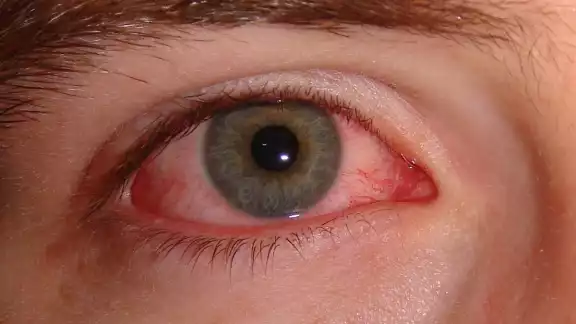Se inflama la conjuntiva, la membrana transparente que recubre el interior del párpado, así como la parte blanca del ojo Se inflama la conjuntiva, la membrana transparente que recubre el interior del párpado, así como la parte blanca del ojo