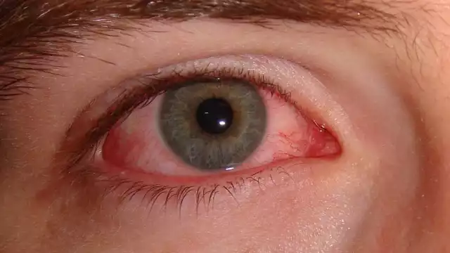 Se inflama la conjuntiva, la membrana transparente que recubre el interior del párpado, así como la parte blanca del ojo