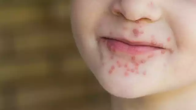 Tankuché logra frenar contagios de coxsackie tras pico de 40 casos