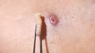 La Secretaría de Salud confirmó el noveno caso de Miasis por gusano barrenador en Campeche.