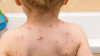 Se registran casi 30 mil casos de varicela en México, estos son los síntomas de alerta
