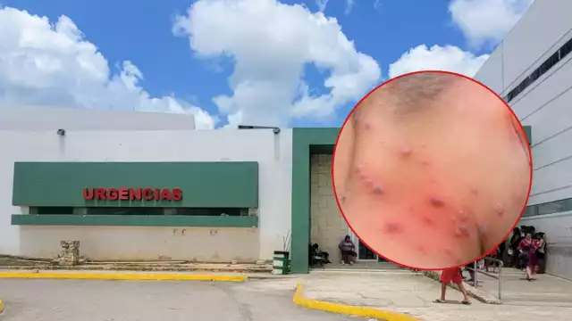 Quintana Roo ocupa el primer lugar en contagios por ronchas de la Península, mientras que Yucatán y Campeche ocupan el segundo y tercero, respectivamente