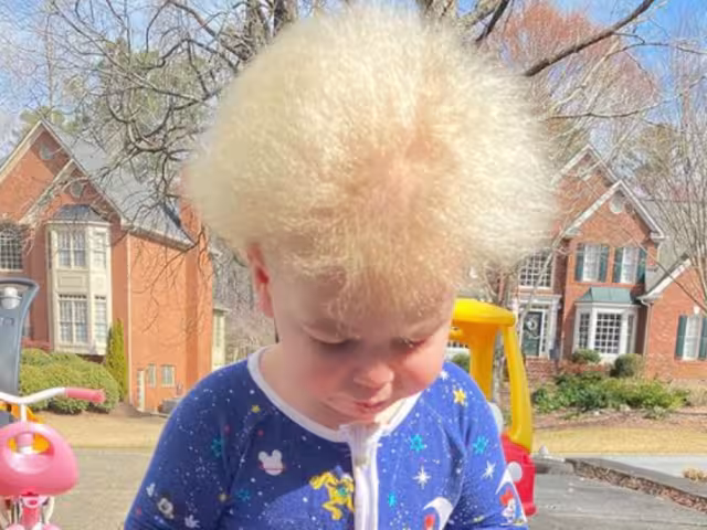 Recientemente  se descubrió que el síndrome de cabello de coco, es causado por mutaciones en uno de 3 genes, PADI3, TGM3 y TCHH