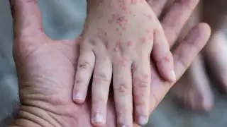 Campeche lidera casos de sarampión en la Península de Yucatán con 12 contagios