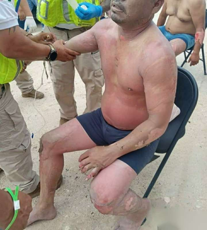 Se reportaron otros trabajadores que sufrieron quemaduras en la mayor parte de su cuerpo Se reportaron otros trabajadores que sufrieron quemaduras en la mayor parte de su cuerpo