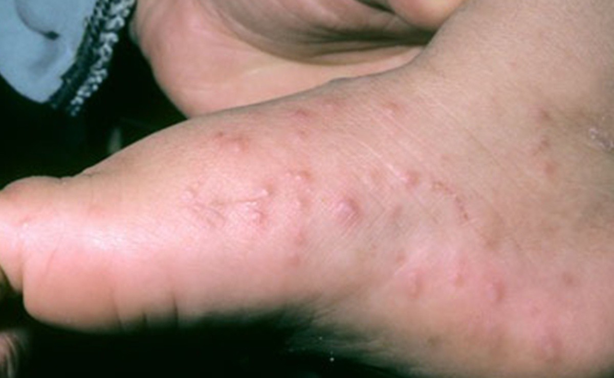 Niños son muy propensos en contagiarse del virus Coxsackie Niños son muy propensos en contagiarse del virus Coxsackie