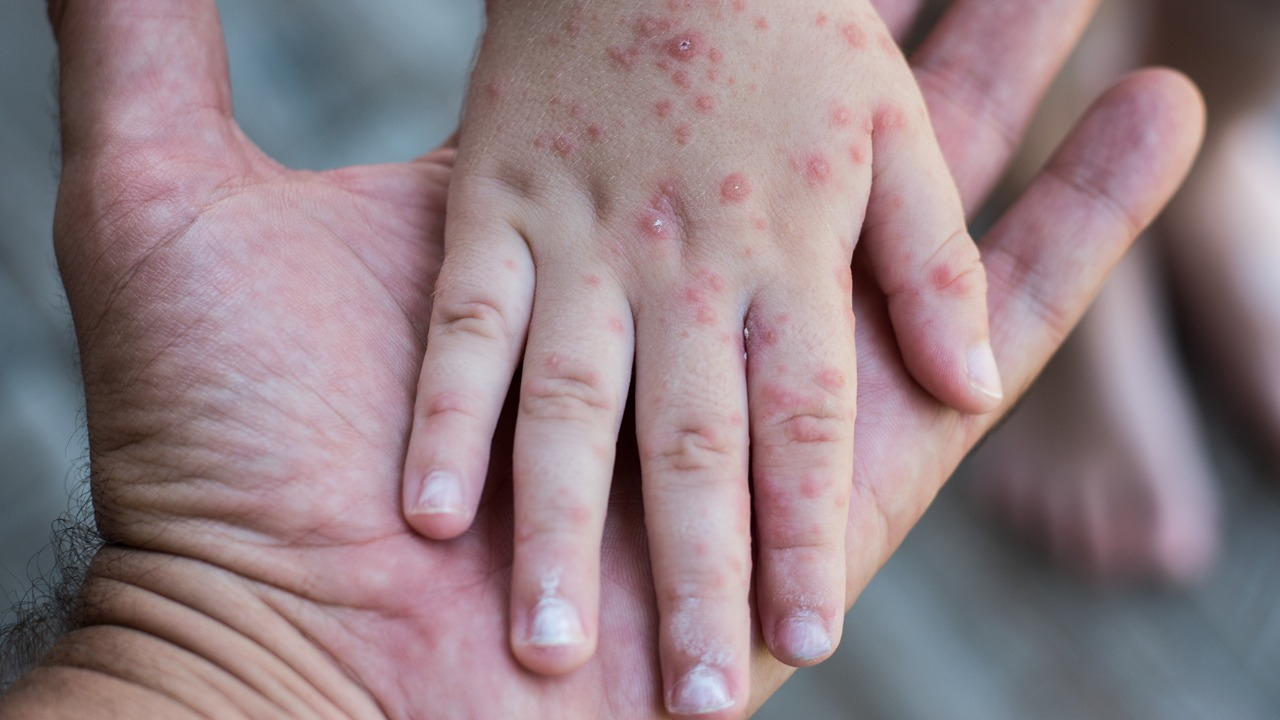 Padres de familia en Yucatán han comenzado a tomar precauciones del virus Coxsackie Padres de familia en Yucatán han comenzado a tomar precauciones del virus Coxsackie