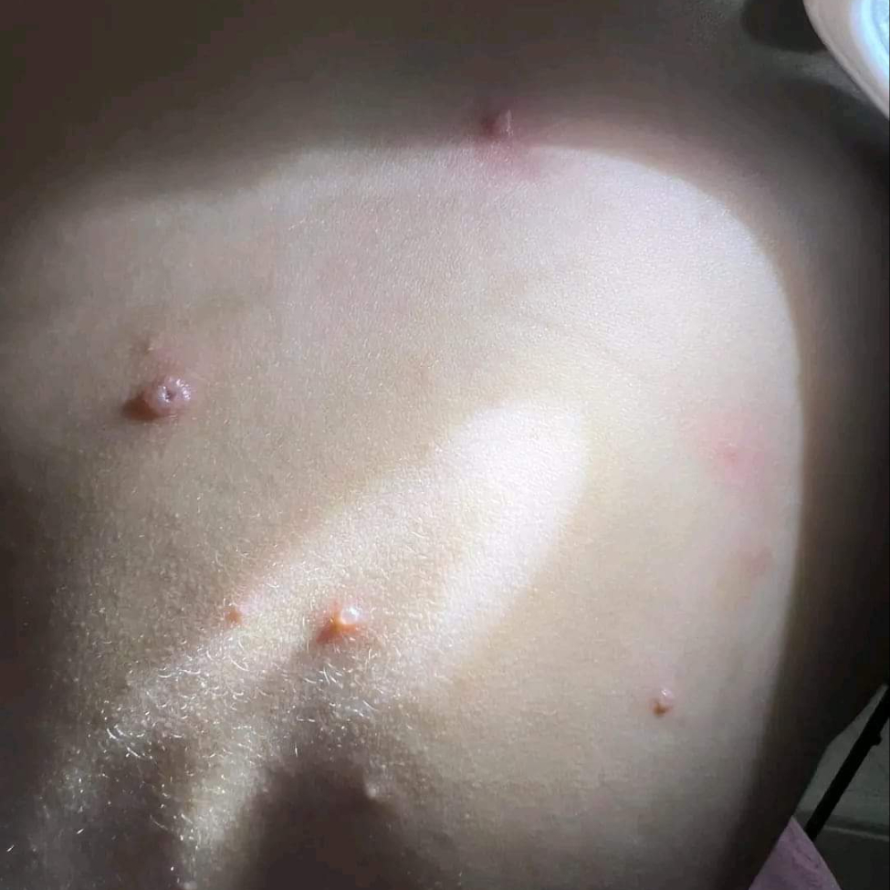 Los primeros casos se registraron en la Secundaria Jacinto Canek, pero los pacientes fueron aislados Los primeros casos se registraron en la Secundaria Jacinto Canek, pero los pacientes fueron aislados