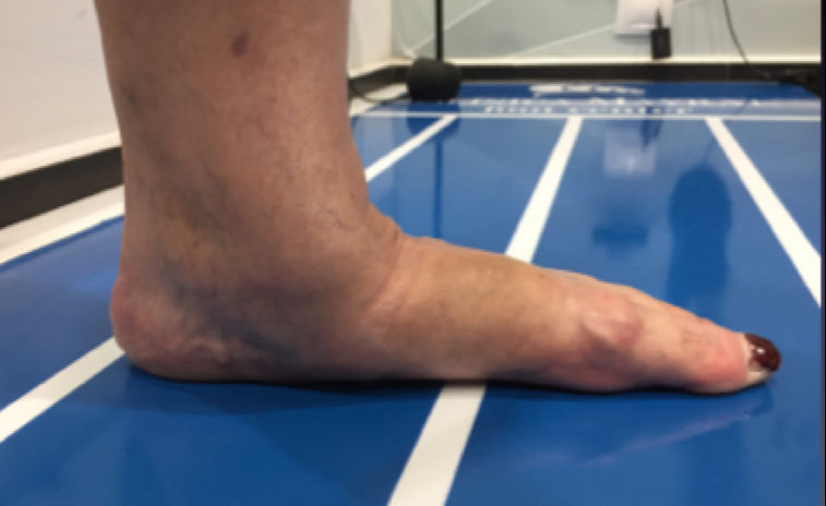 Dos de cada 10 niños no desarrollan el arco de los pies Dos de cada 10 niños no desarrollan el arco de los pies