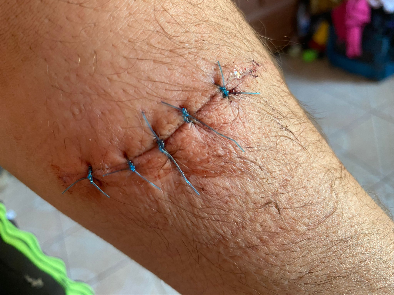 El sujeto recibió 10 puntadas en la herida del antebrazo izquierdo por un machete El sujeto recibió 10 puntadas en la herida del antebrazo izquierdo por un machete