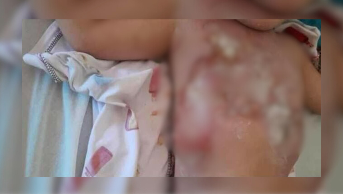   En Champotón, piden ayuda para menor de dos años con quemaduras de segundo grado   