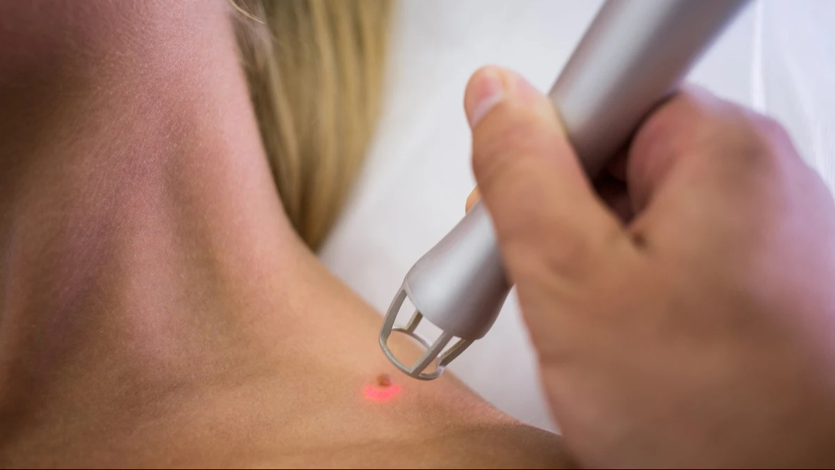 Cofepris realizará ensayo clínico de la vacuna en contra del melanoma