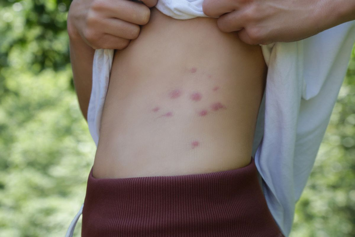 Se presenta dolor de cabeza por la fiebre de Oropouche Se presenta dolor de cabeza por la fiebre de Oropouche