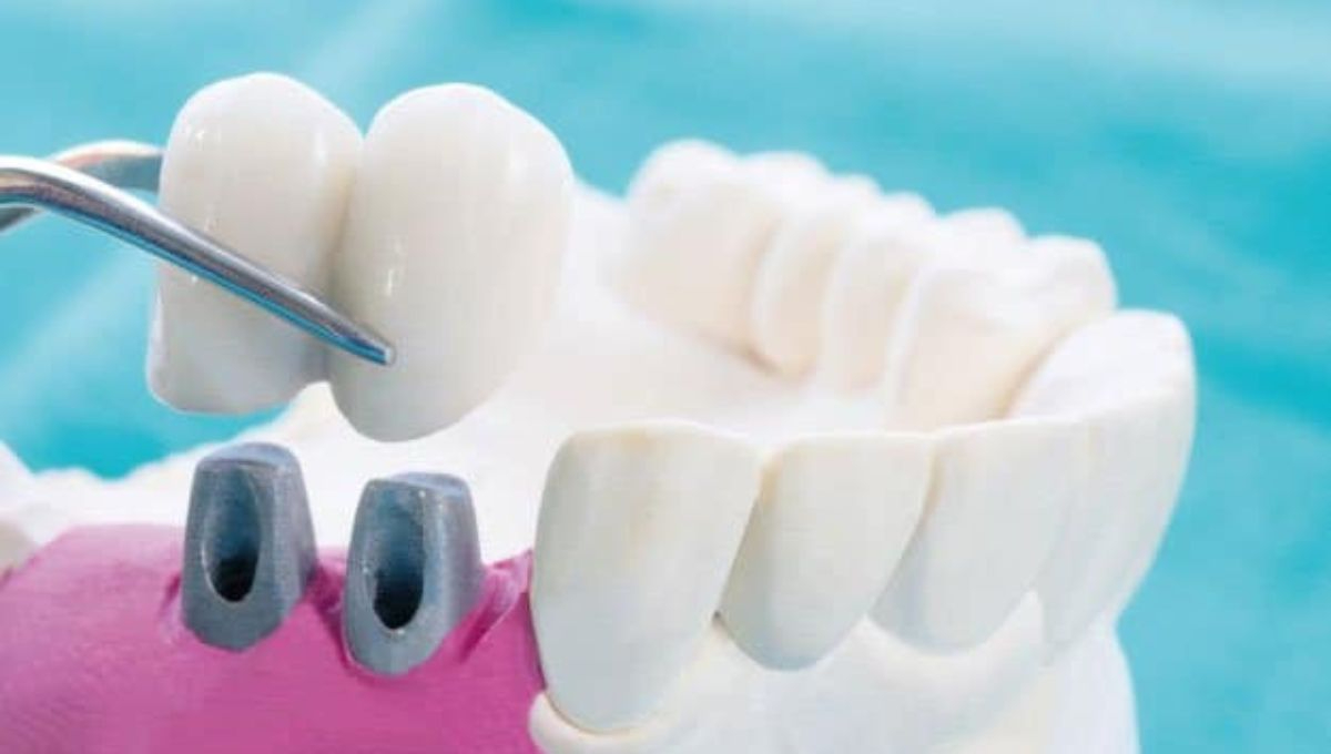 Empresa china habría robado alrededor de cuatro mil cadáveres de crematorios para fabricar prótesis dentales Empresa china habría robado alrededor de cuatro mil cadáveres de crematorios para fabricar prótesis dentales