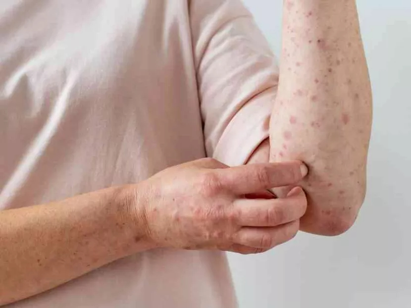 Autoridades de Salud exhortan a los viajeros a prevenirse al trasladarse a países con reporte de casos Autoridades de Salud exhortan a los viajeros a prevenirse al trasladarse a países con reporte de casos