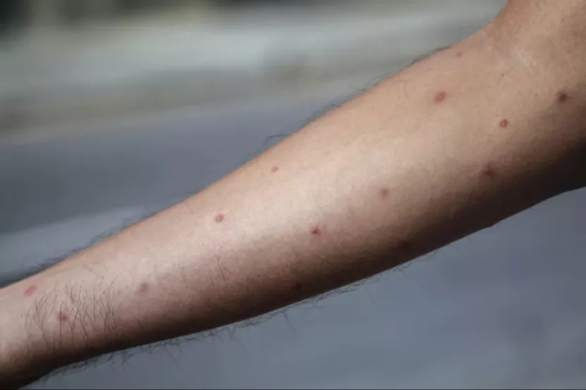 El mpox se ha registrado en su mayoría en África El mpox se ha registrado en su mayoría en África