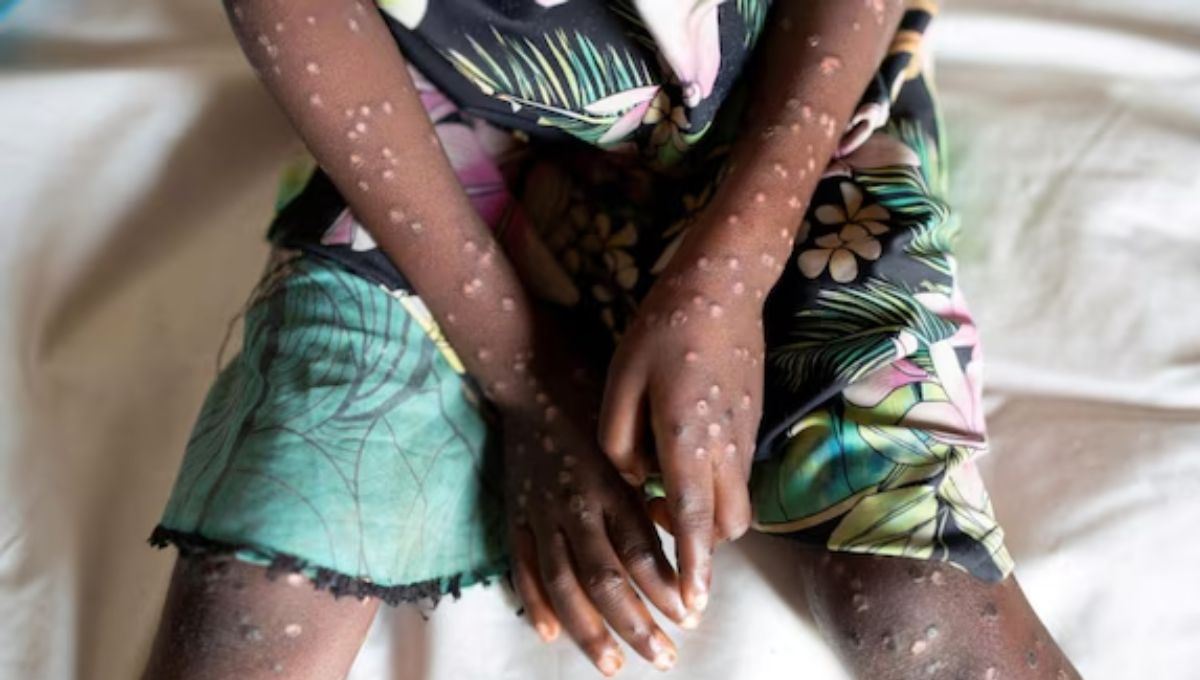 Quintana Roo registra 8 casos de mpox en 2024