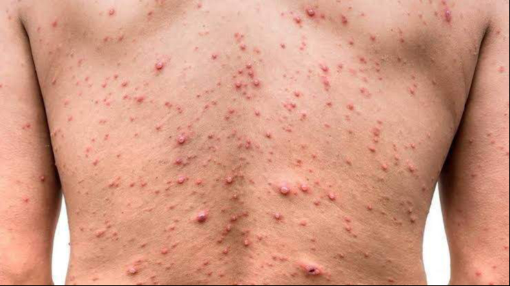 Así podría lucir la viruela símica en el cuerpo Así podría lucir la viruela símica en el cuerpo