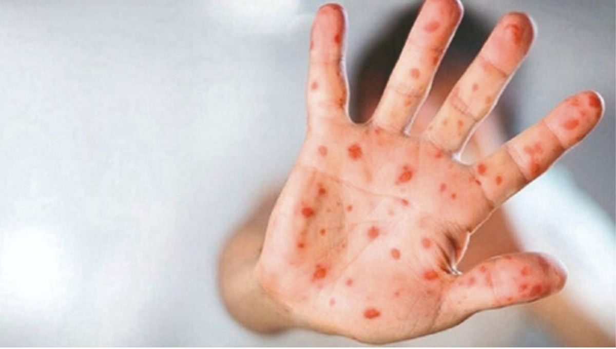 Suma otro caso de Mpox en Quintana Roo